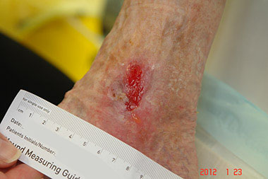 Granulation of wound