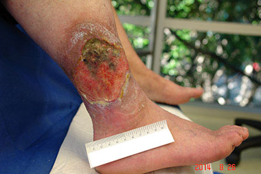 Necrotic wound tissue